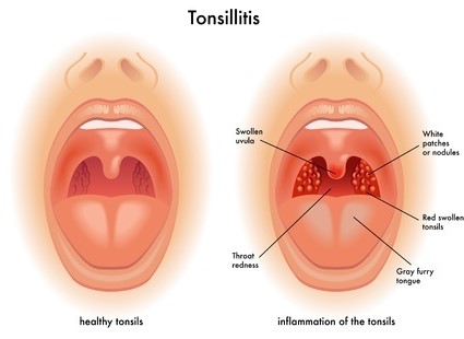 tonsille