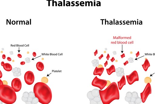 anemia mediterranea