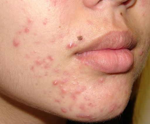 acne