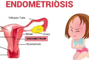 Endometriosi
