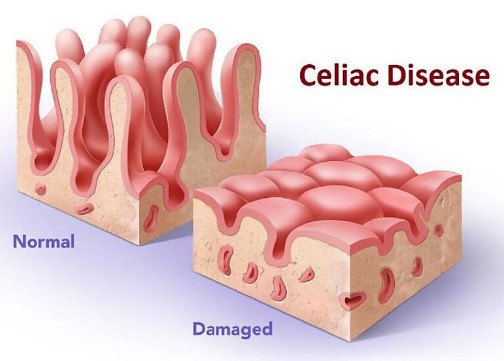 Celiachia