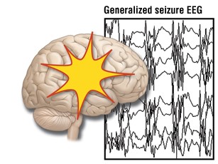epilessia
