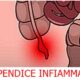 appendicite