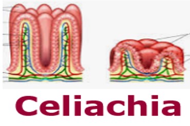 celiachia