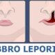 labbro leporino