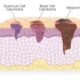 pesticidi e melanoma