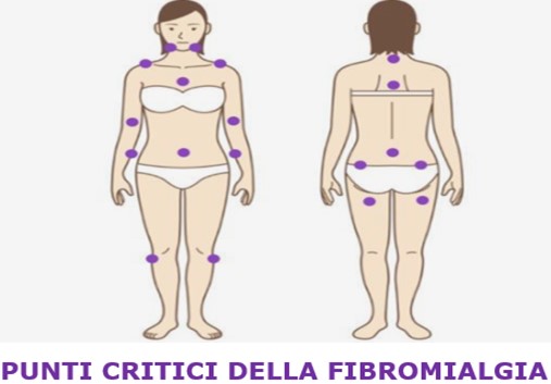 fibromialgia punti dolore