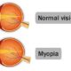 miopia
