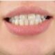 macchie sui denti