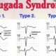 sindrome di brugada