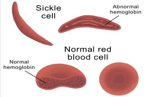 cura anemia mediterranea