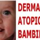 dermatite atopica
