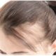 alopecia nei giovani