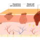 melanoma