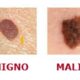 melanoma e prevenzione