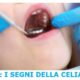 celiachia campanello allarme denti
