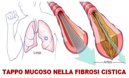 fibrosi cistica