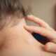 dermatite atopica e disturbi psiche