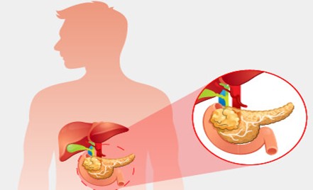 tumore al pancreas