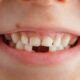 la caduta dei denti da latte