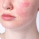 rosacea