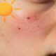 effetti del sole sull'acne