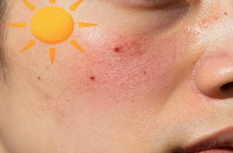 effetti del sole sull'acne